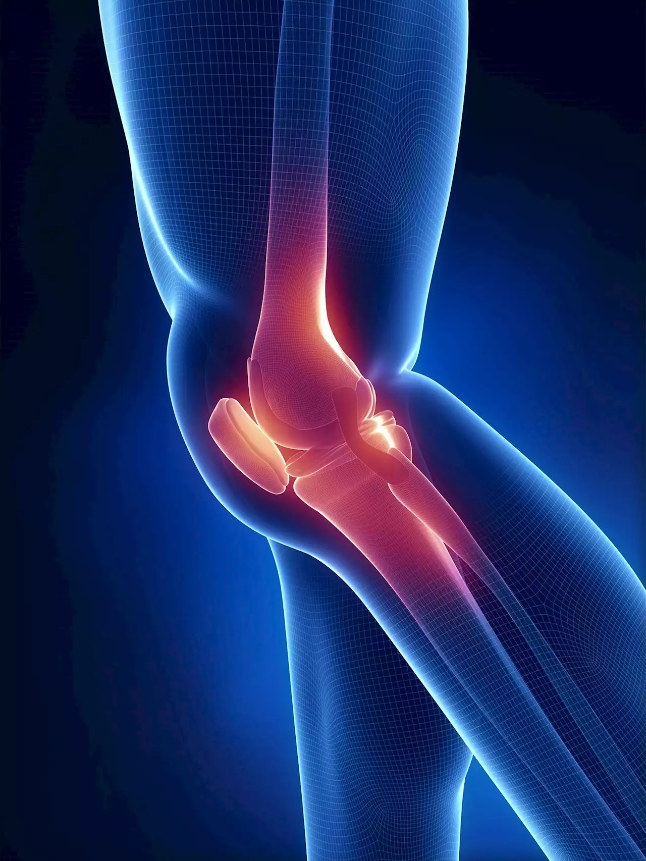 Fixing Knee Pain: New Cartilage Substitute Is Better Than the Real Thing