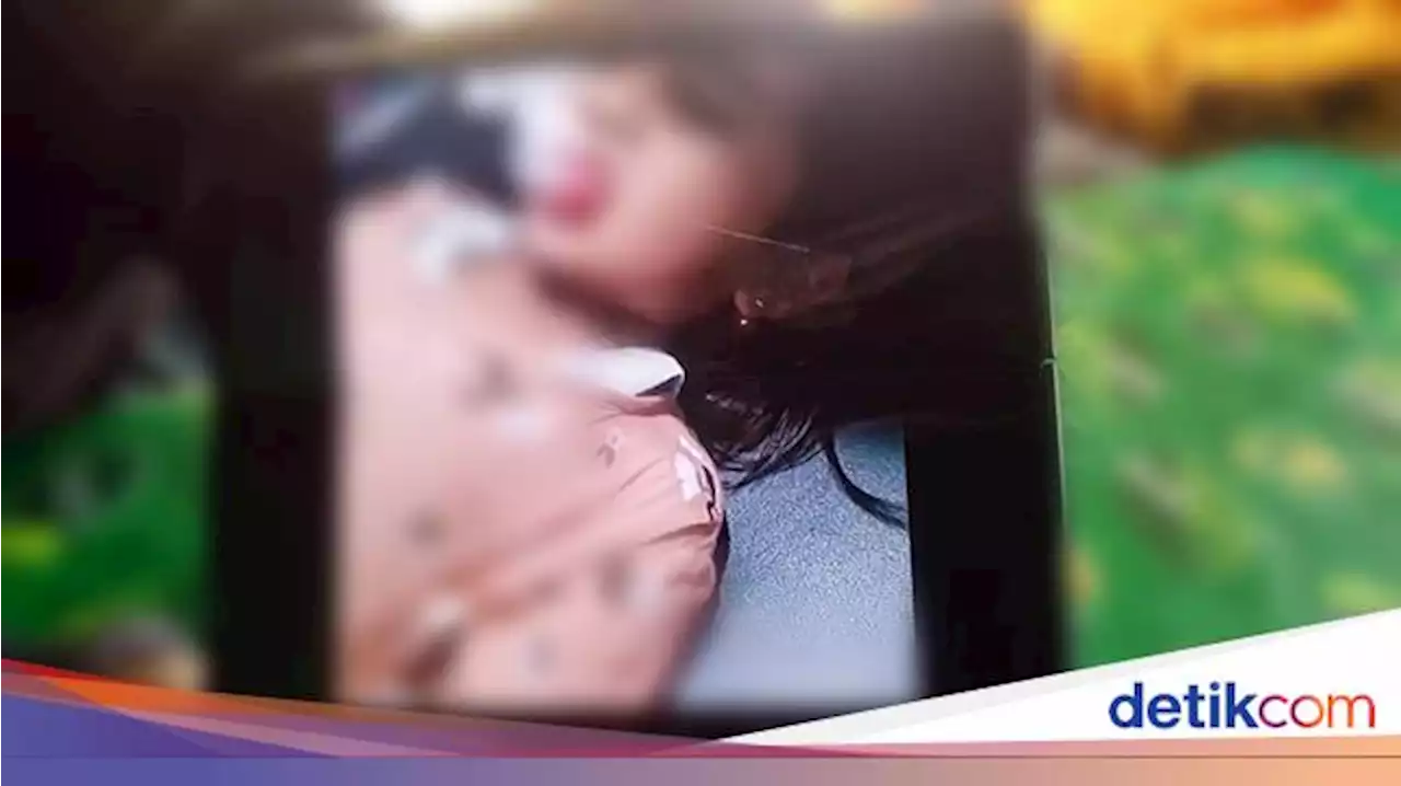 Bibir Anak 5 Tahun di Sukabumi Kena Hantaman Lato-lato, Berakhir Dijahit