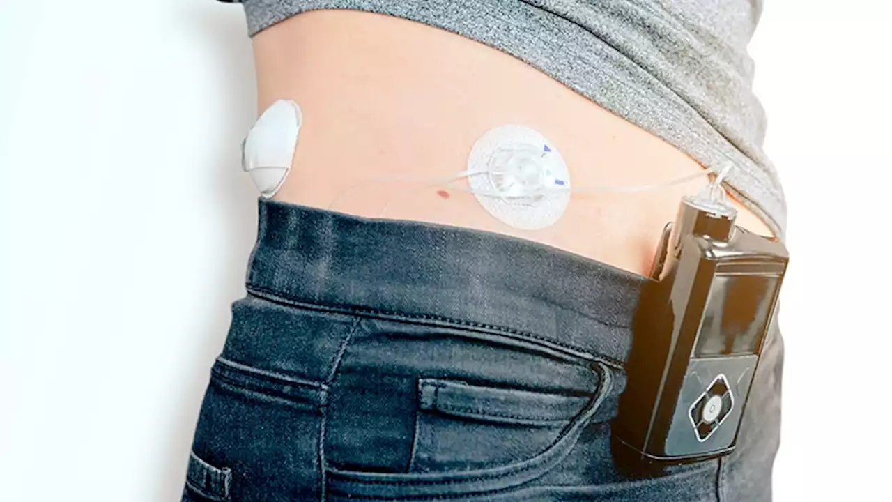 'Artificial Pancreas' Technology to Change Lives in Type 1 Diabetes