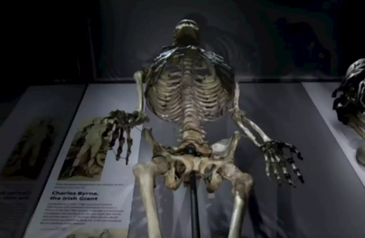 Skeleton of Irish 'giant' to be removed from display at London museum due to ethical concerns