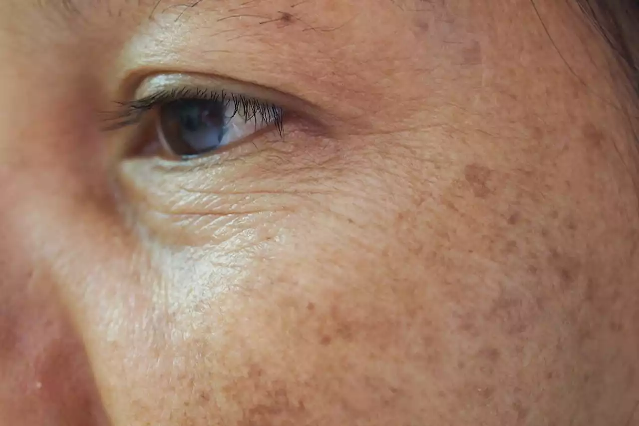 Anti-wrinkle patch uses microneedle injections to restore skin