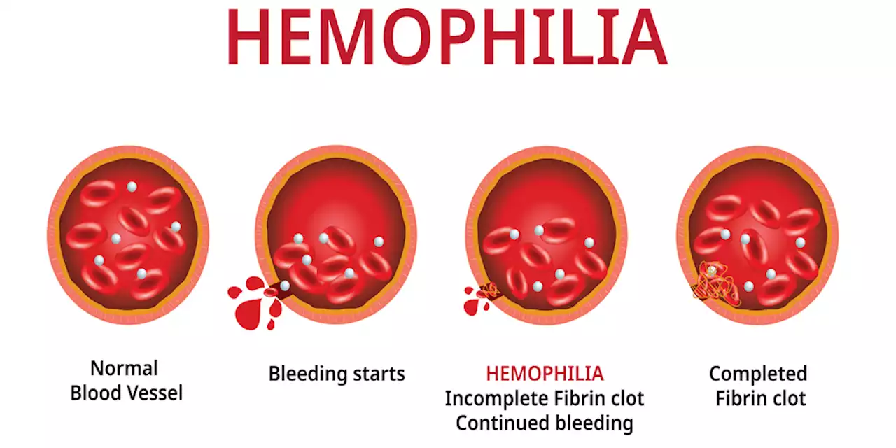 Clinical Quiz: Are You Ready for Hemophilia Gene Therapy?