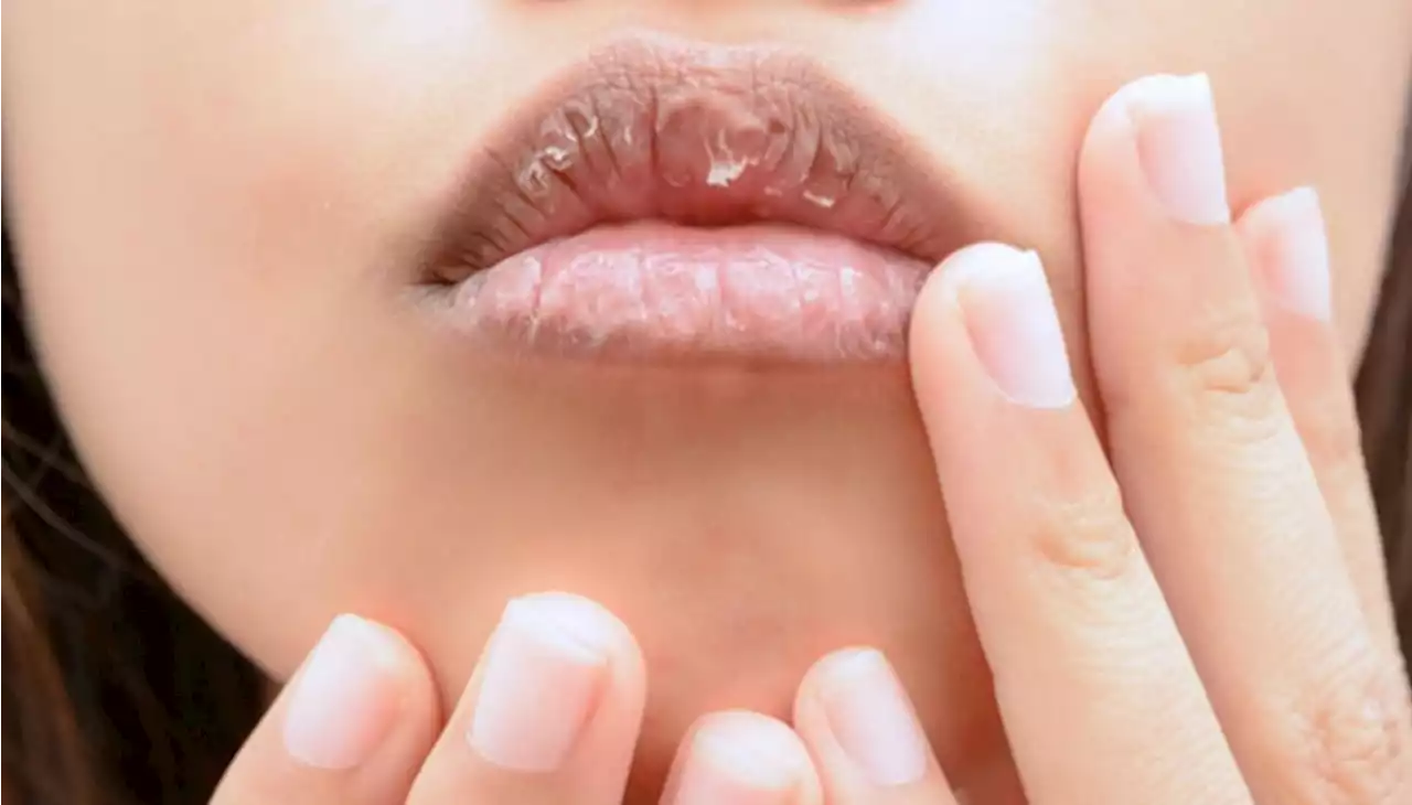 6 Penyebab Bibir Kering, Bisa jadi Salah Pilih Lip Balm