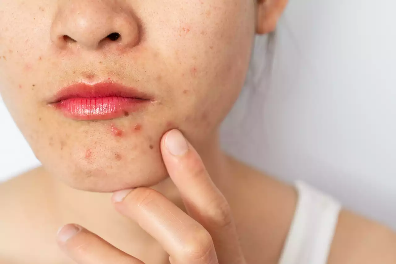 I'm a doctor - here's how to 'cure' adult acne & the products that really work