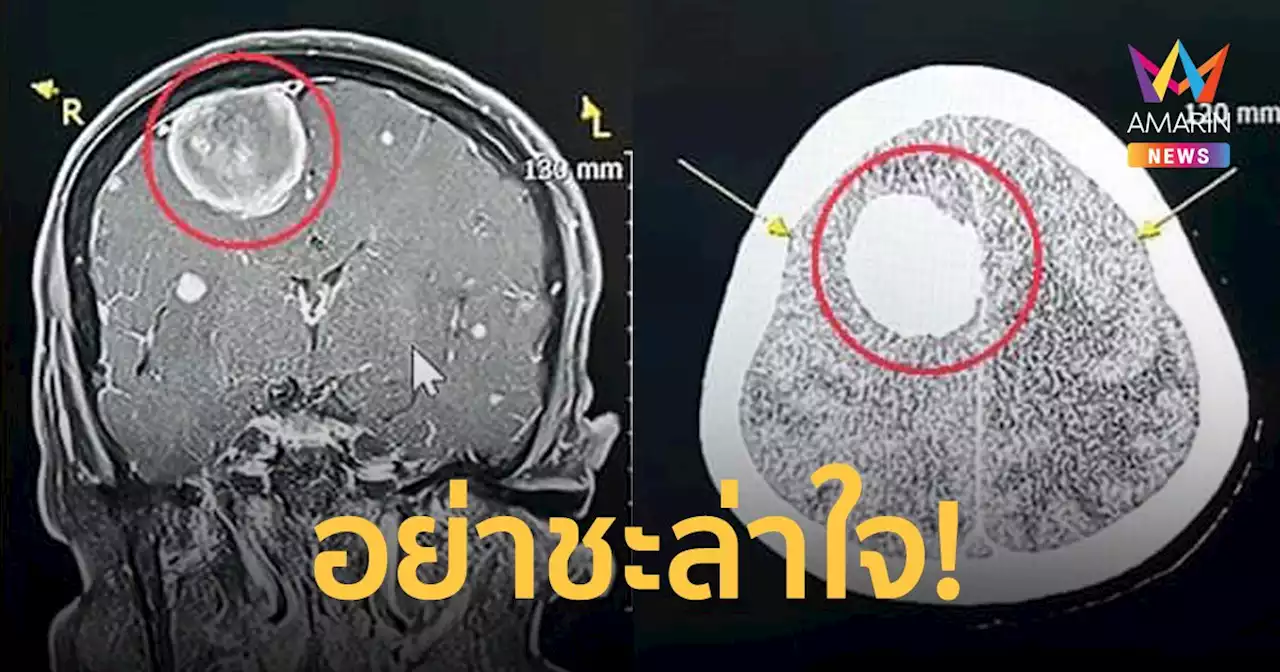 หมอเตือน! ปวดหัวบ่อยอย่าชะล่าใจ อาจป่วยเป็นโรคเนื้องอกเยื่อหุ้มสมอง