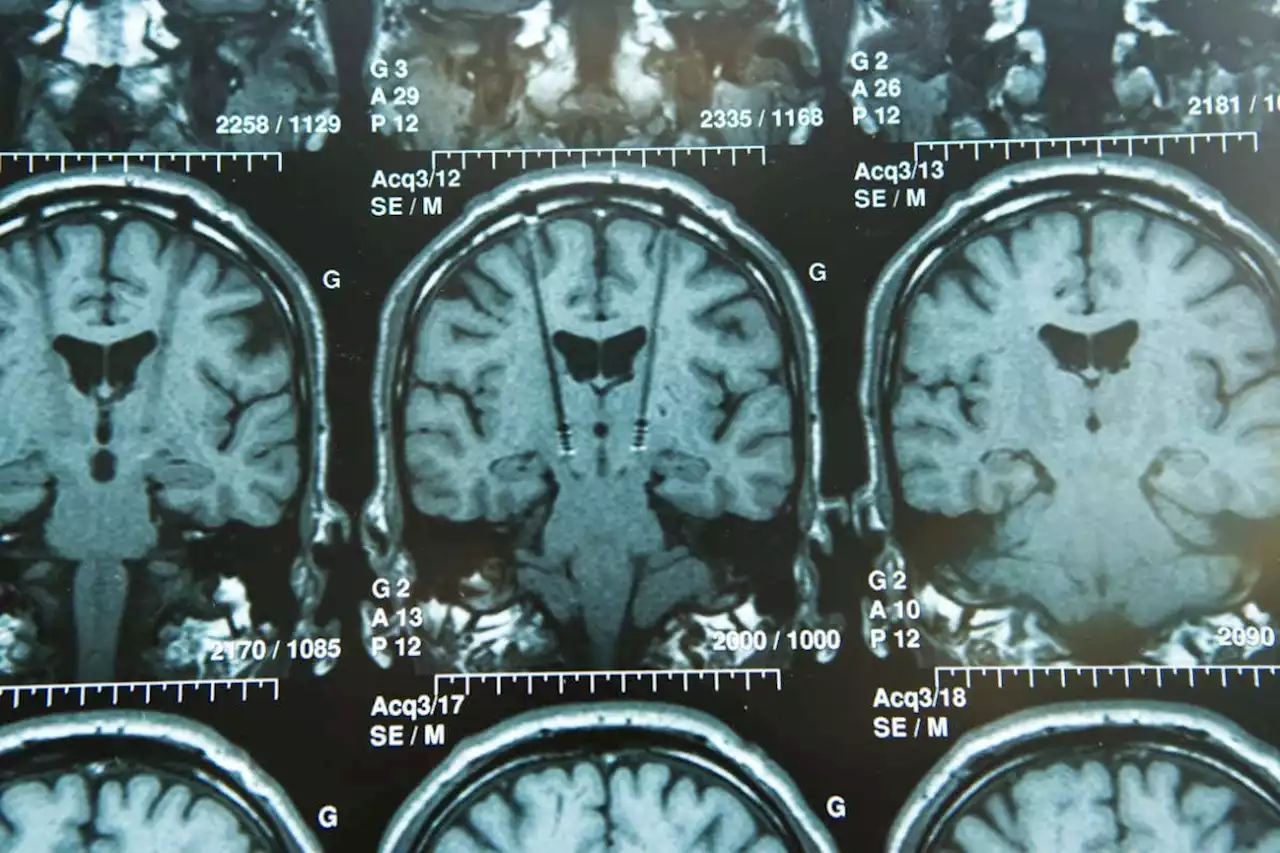 Deep brain stimulation could reduce emotional impact of memories