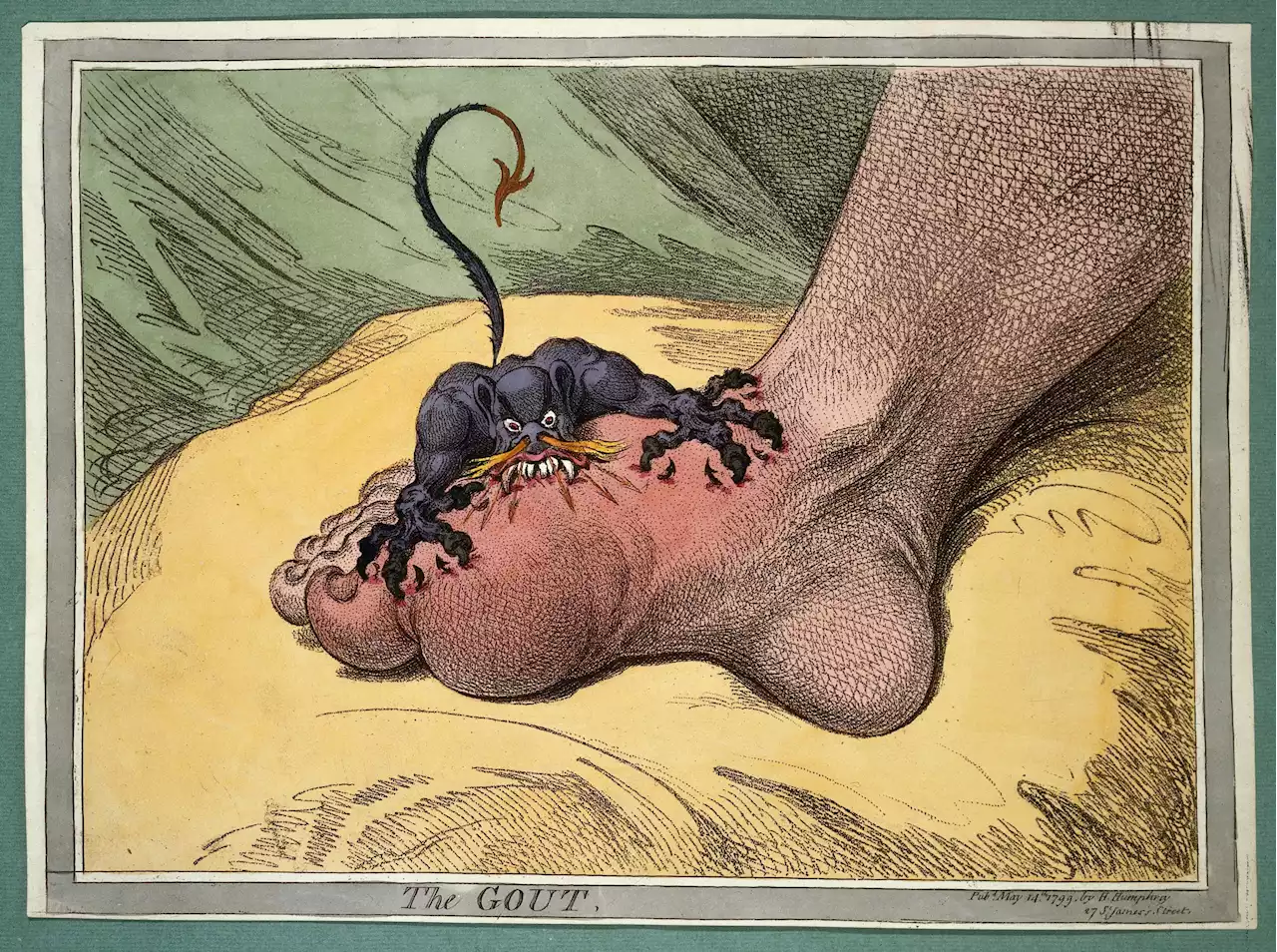 A New Model of an Ancient Disease: Study Identifies Novel Treatment Targets for Gout