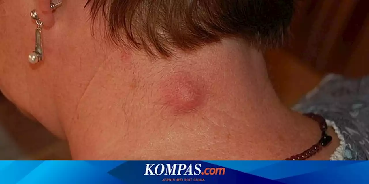 Mengenal Apa Itu Kista Epidermoid, Penyebab, dan Gejalanya