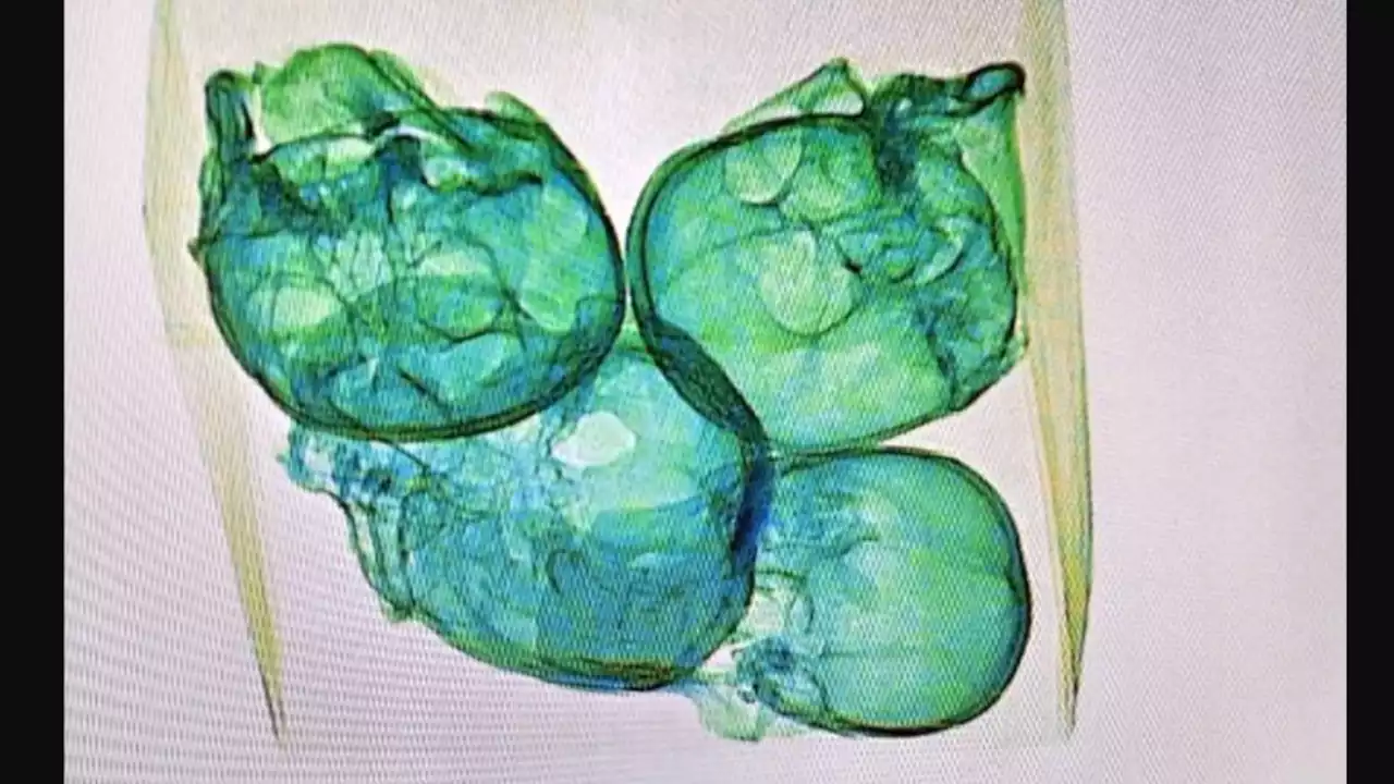 X-ray at Airport in Mexico Reveals Human Skulls in Package Bound for U.S.