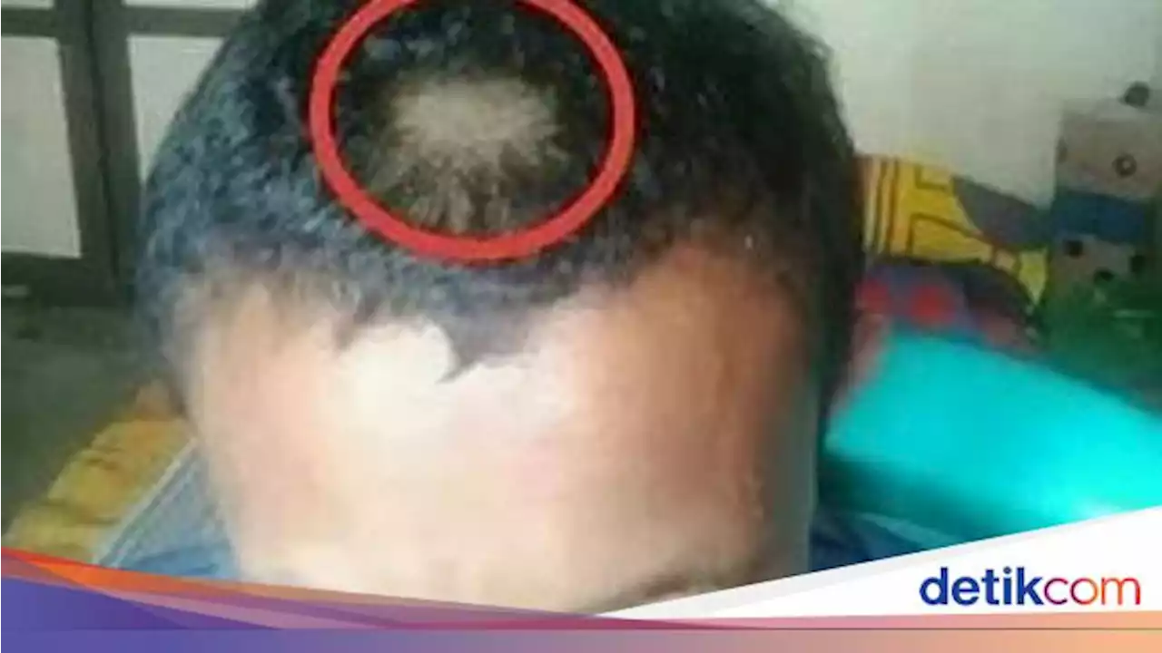 Emosi Anaknya Dihukum, Ortu Siswa SD di Gorontalo Cukur Paksa Rambut Guru