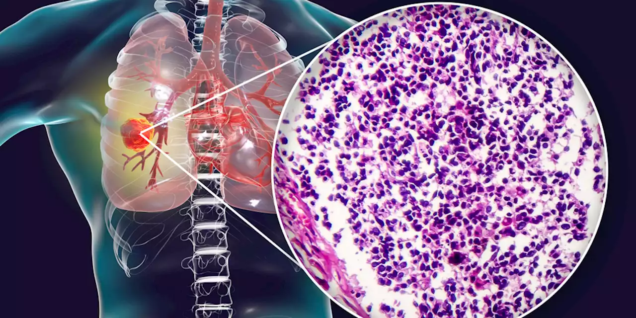 RET Inhibitors for RET-Altered Non-Small Cell Lung Cancer: Identification, Treatment, and Practicalities