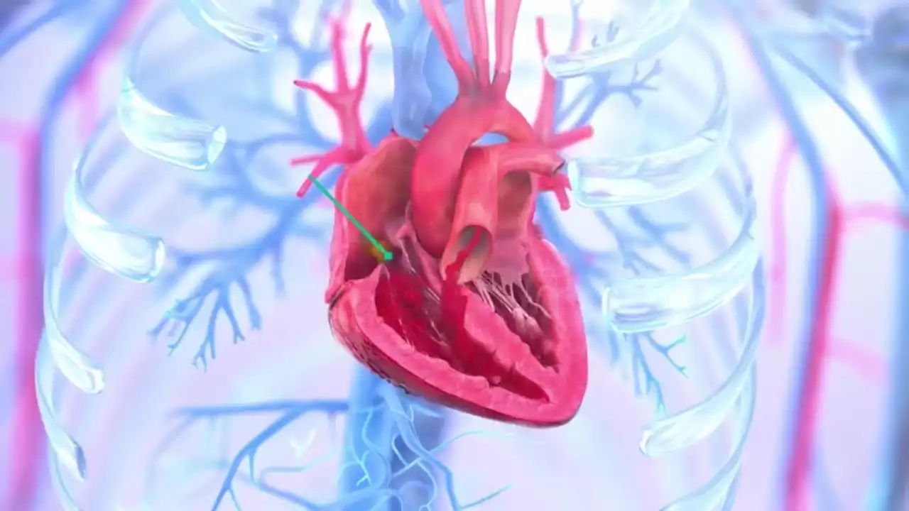 Out of Time and Options: Saving Steven's Heart with TTVR