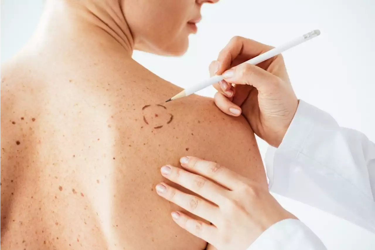 Metastatic Melanoma: key protein identified that aids the spread of skin cancer