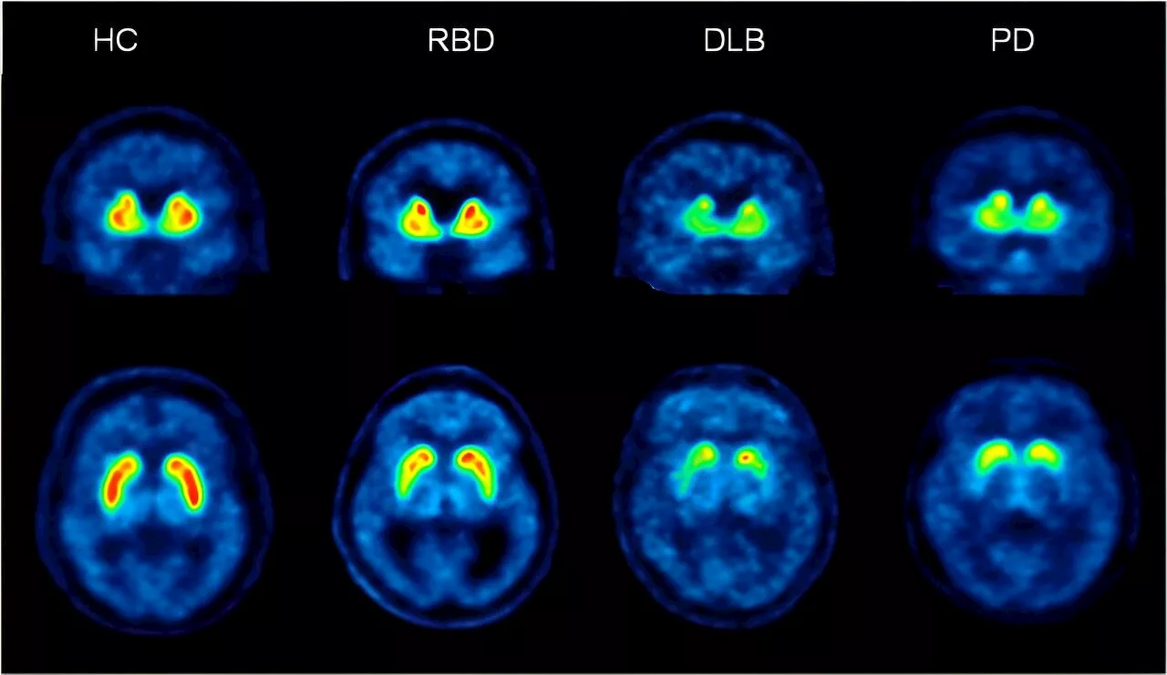 Detecting Parkinson's disease decades before symptoms appear