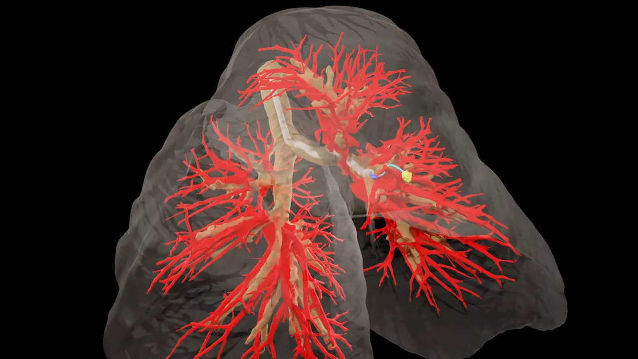 Autonomous robotic needle can maneuver through living tissue