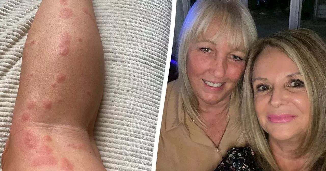 Blackpool hotel guests' horror after waking up with 200 bed bug bites