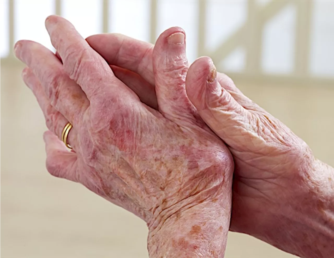 Researchers call for urgent improvement in pain management for inflammatory arthritis patients