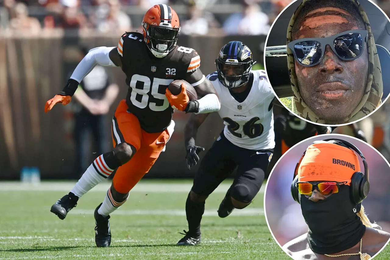 Browns' David Njoku reveals intense facial burns he suffered in nasty fire pit accident