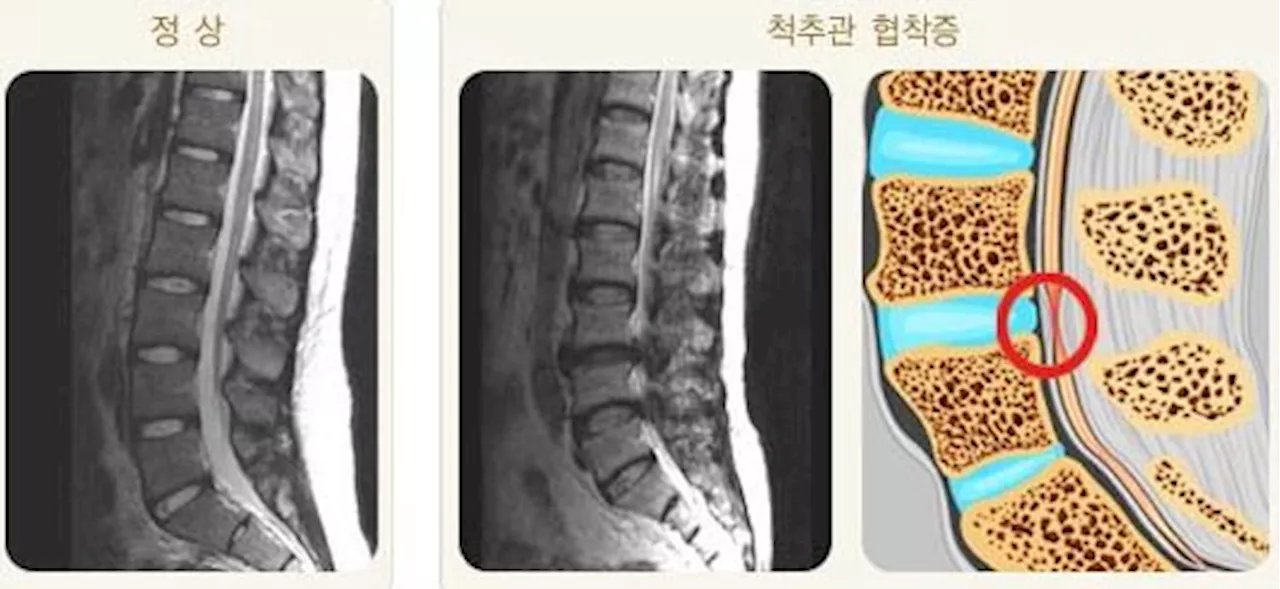 ‘꼬부랑 노인’ 척추관협착증, 조기 치료 ‘허리 업’