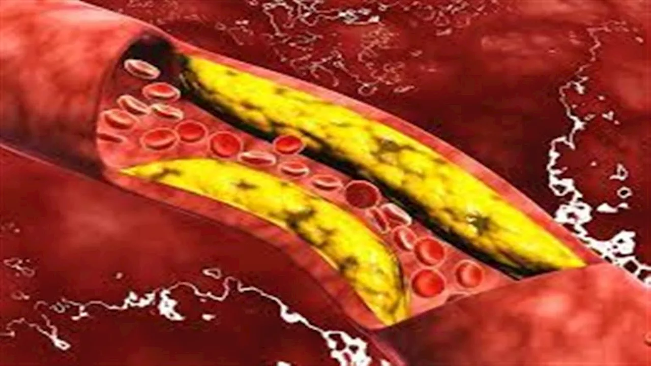 3 علامات خطيرة بالجسم تشير إلى ارتفاع الكوليسترول