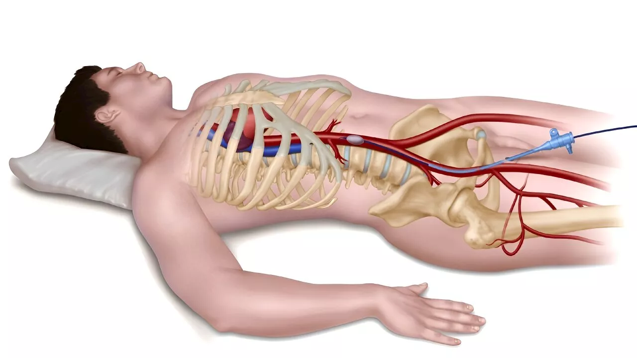 New treatment for severe bleeding after injury does not show benefit in clinical trial