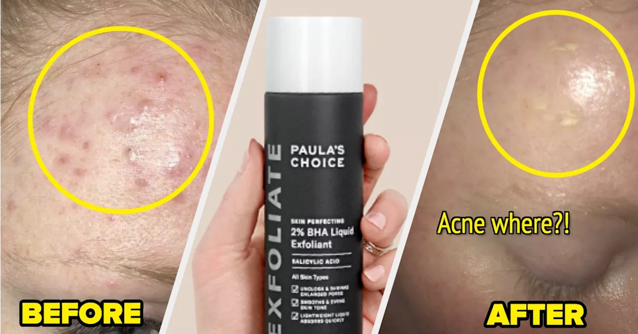 22 Products That Users Swear By For Healing Cystic Acne