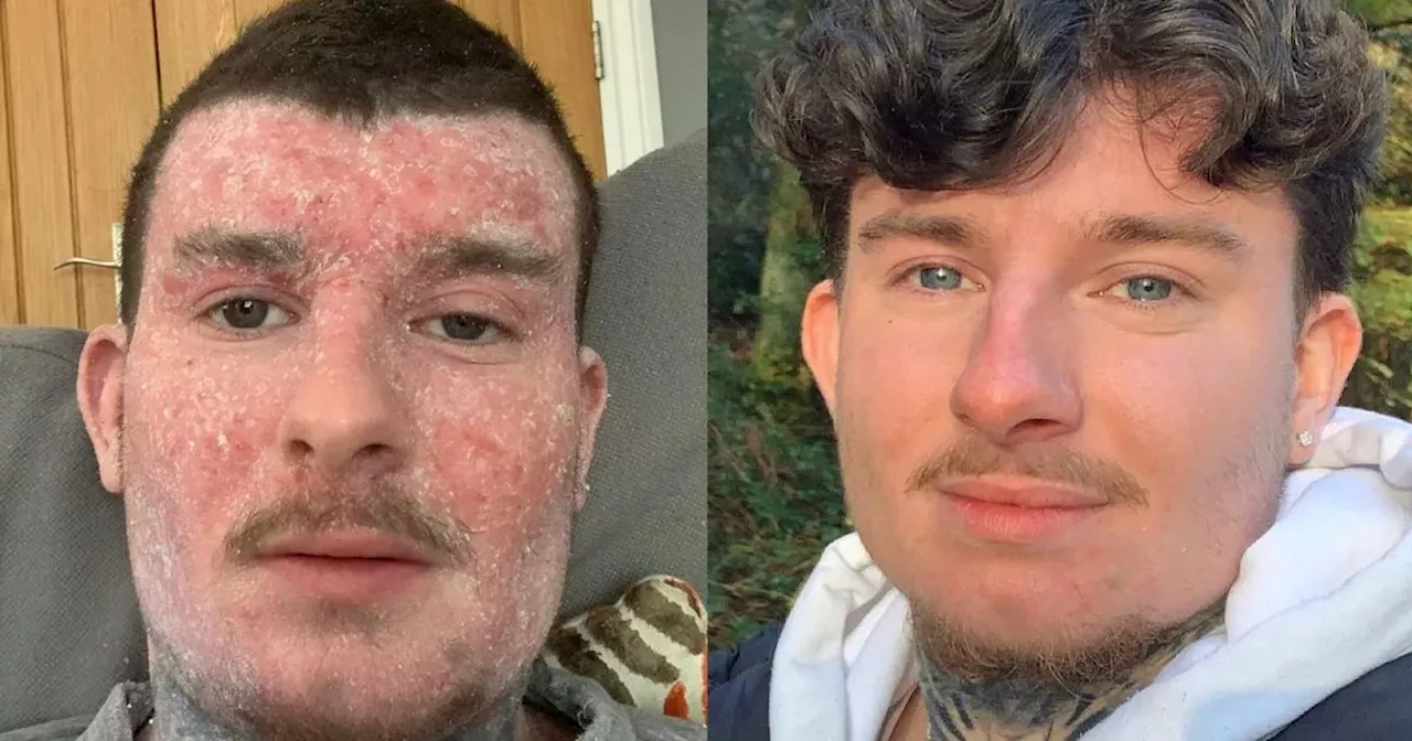 Rhys was bedbound by eczema, but sister's product changed his life