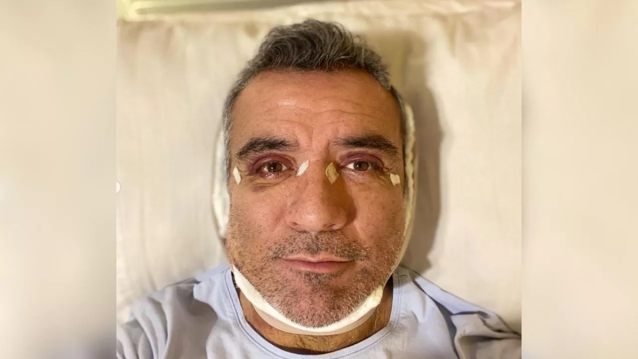 ¡Qué guapo! Así luce Héctor Sandarti a 17 días de su cirugía estética