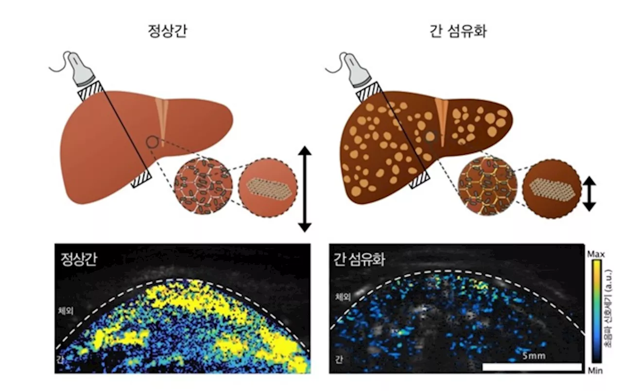 병들어 ‘딱딱해진 장기’ 알아낼 신기술 개발