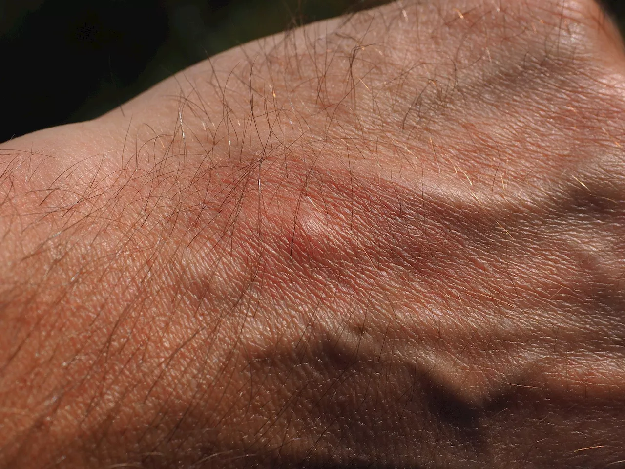 An itching paradox—a molecule that triggers the urge to scratch also turns down inflammation in the skin