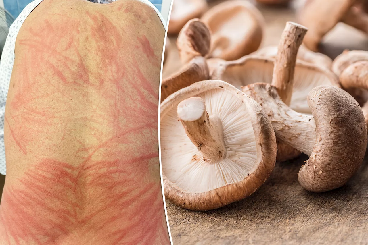 Man suffers rare ‘shiitake rash’ from undercooked mushroom