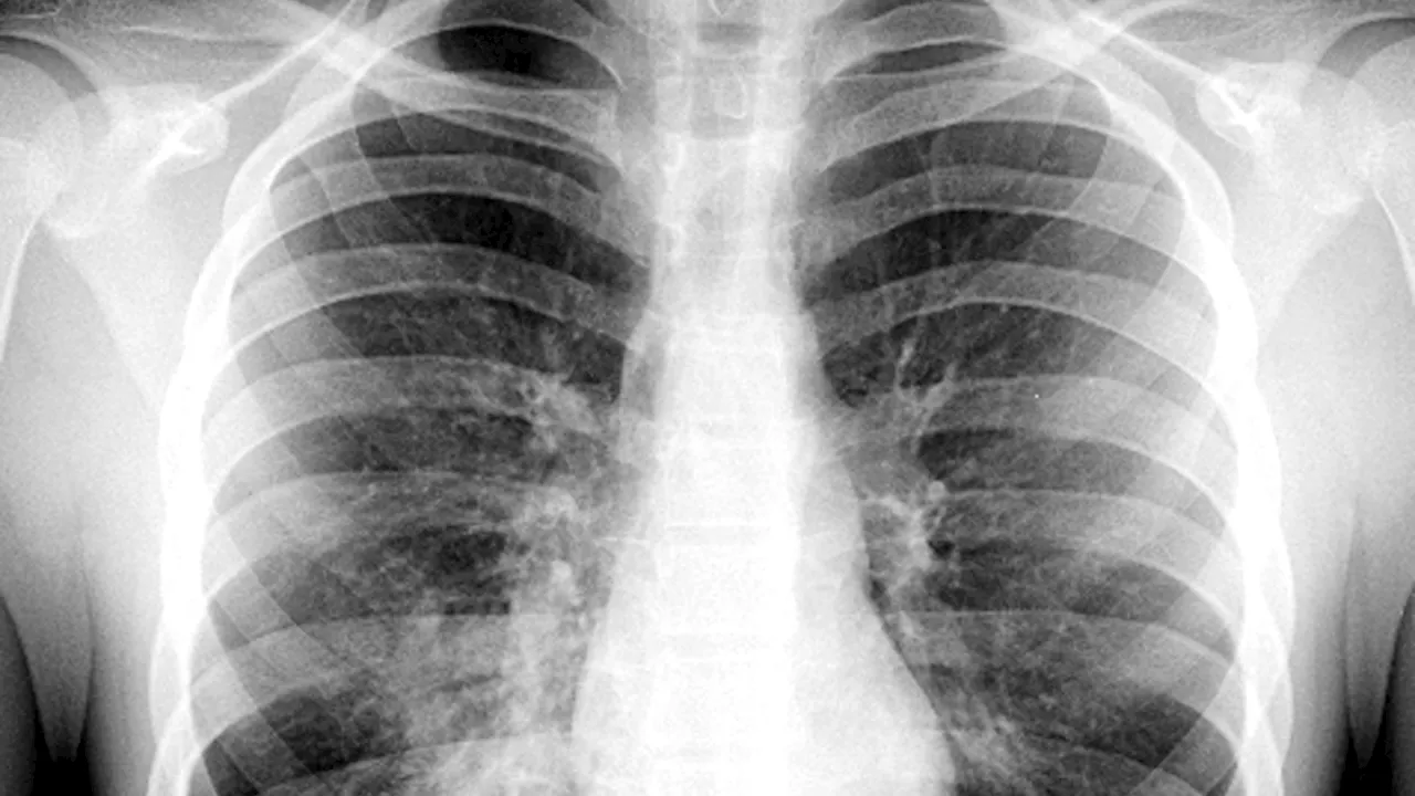 There are actually 4 types of pneumonia. These are the differences.