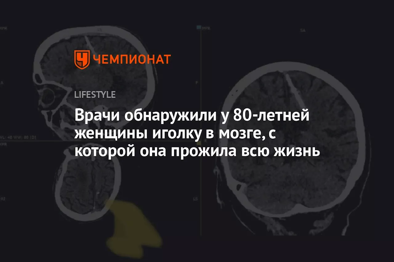 Врачи обнаружили у 80-летней женщины иголку в мозге, с которой она прожила всю жизнь