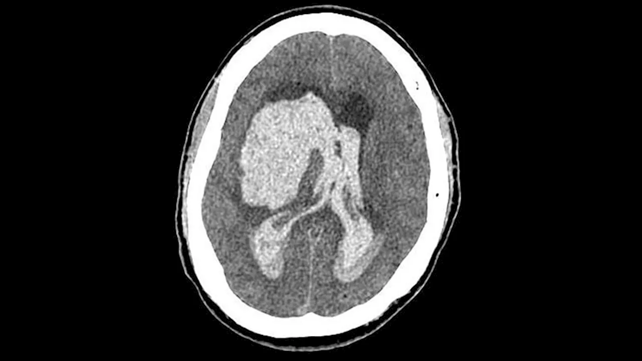 Oral Anticoagulation in ICH Patients With AF: New Data