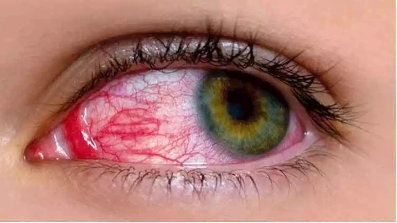 Experts say use of antibiotics, steroids in conjunctivitis can affect eyesight