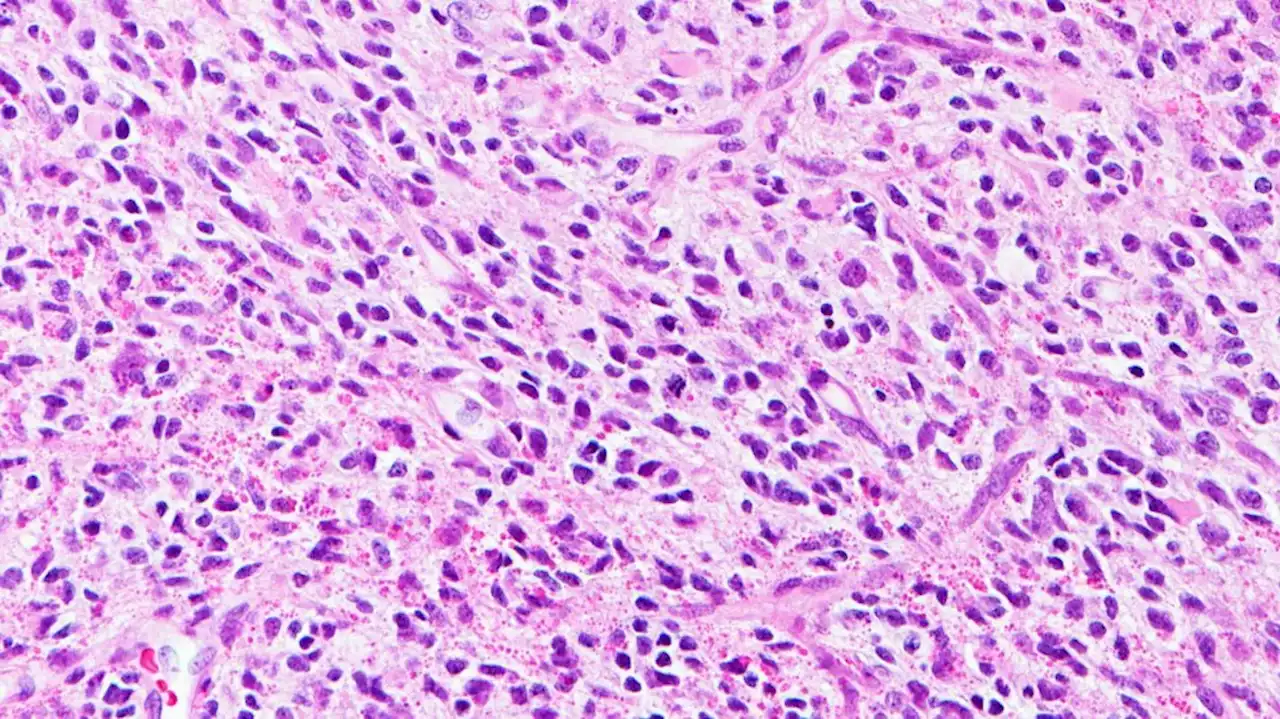 Single set of criteria to assess progression in glioma aims to speed discovery of new medicines