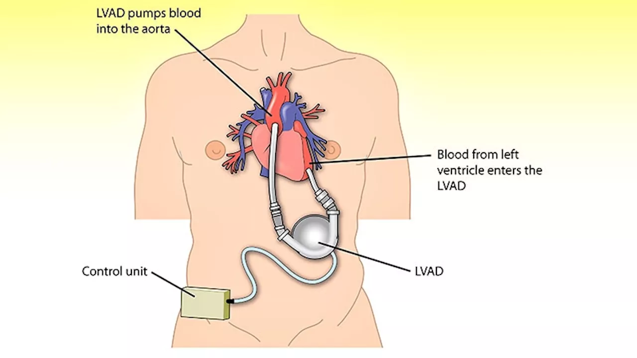 Durable LVAD for Advanced HF Still Underutilized