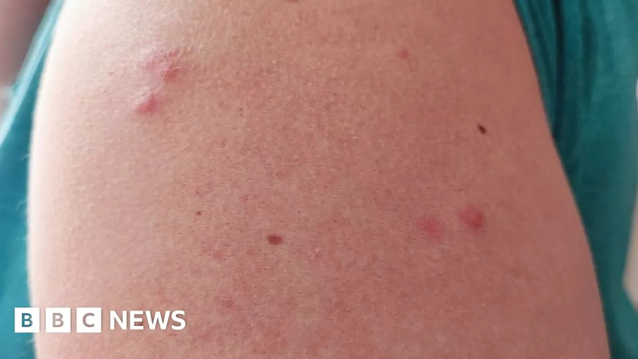 Premier Inn 'bedbug bites' case leads to compensation