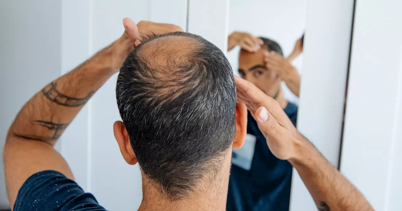 Hope as German researchers discover baldness genes 'for first time ever'