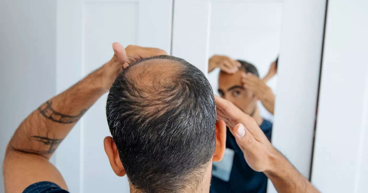 Male hair loss linked to five rare gene variants, according to research