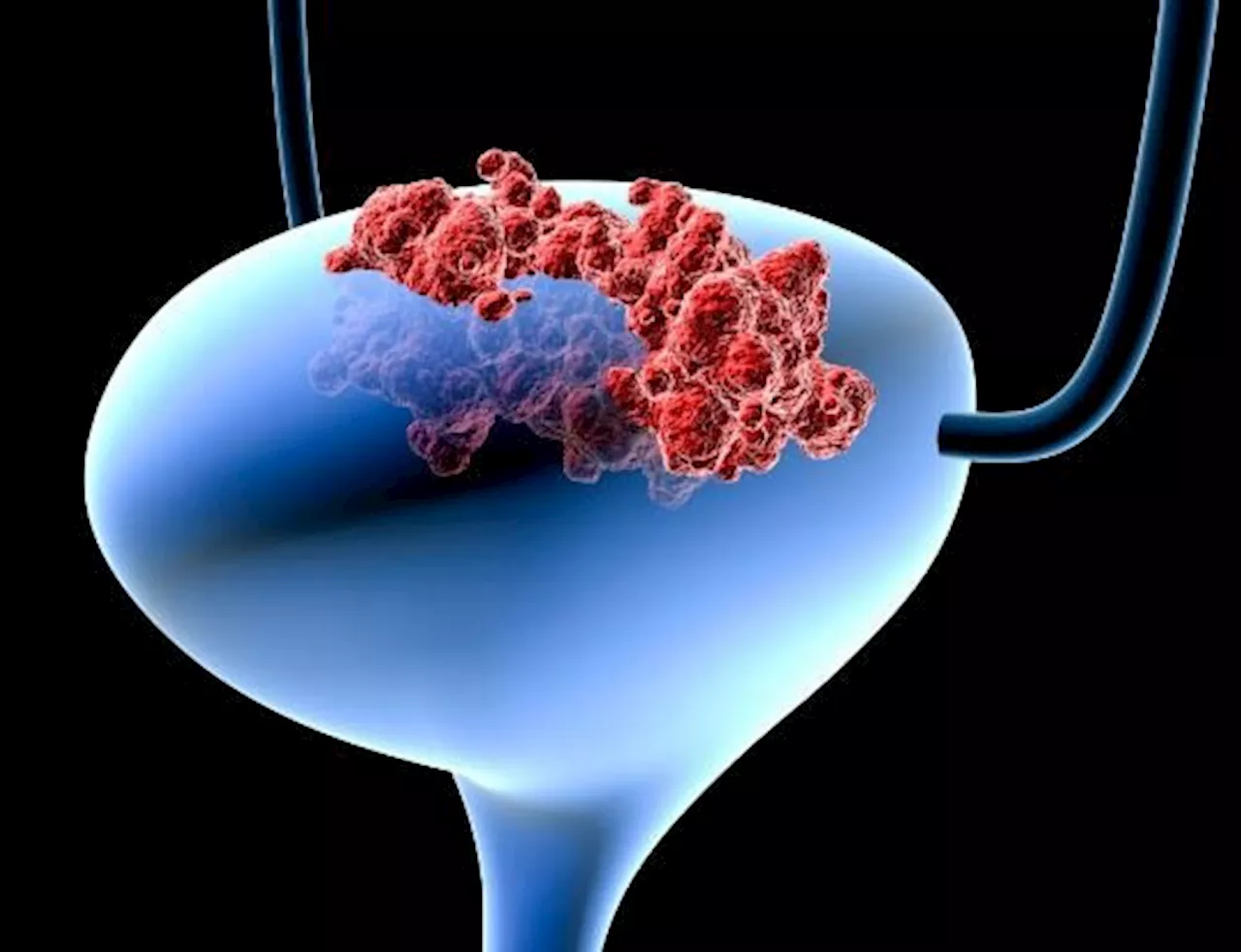 روشی موثرتر از شیمی‌درمانی برای درمان سرطان مثانه