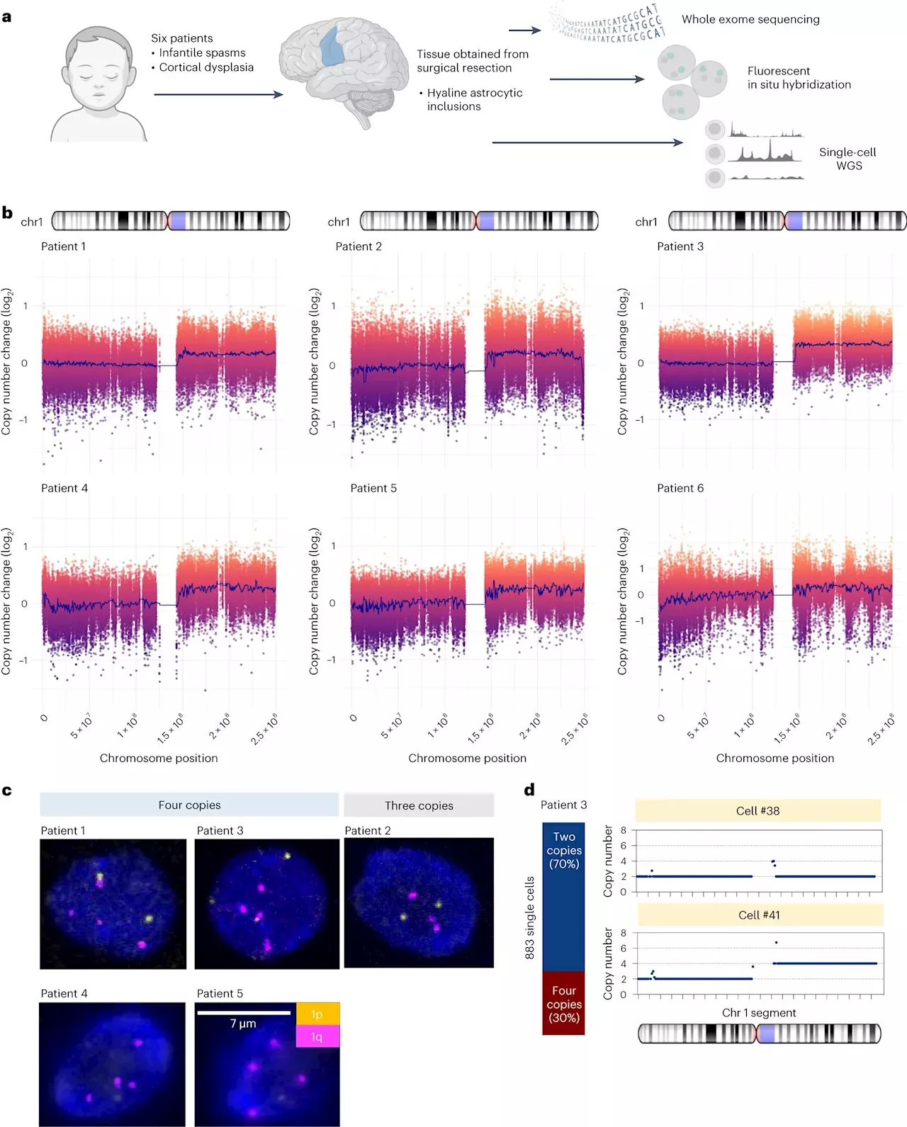 Novel Cause Of Brain Mosaicism And Focal Epilepsy Identified