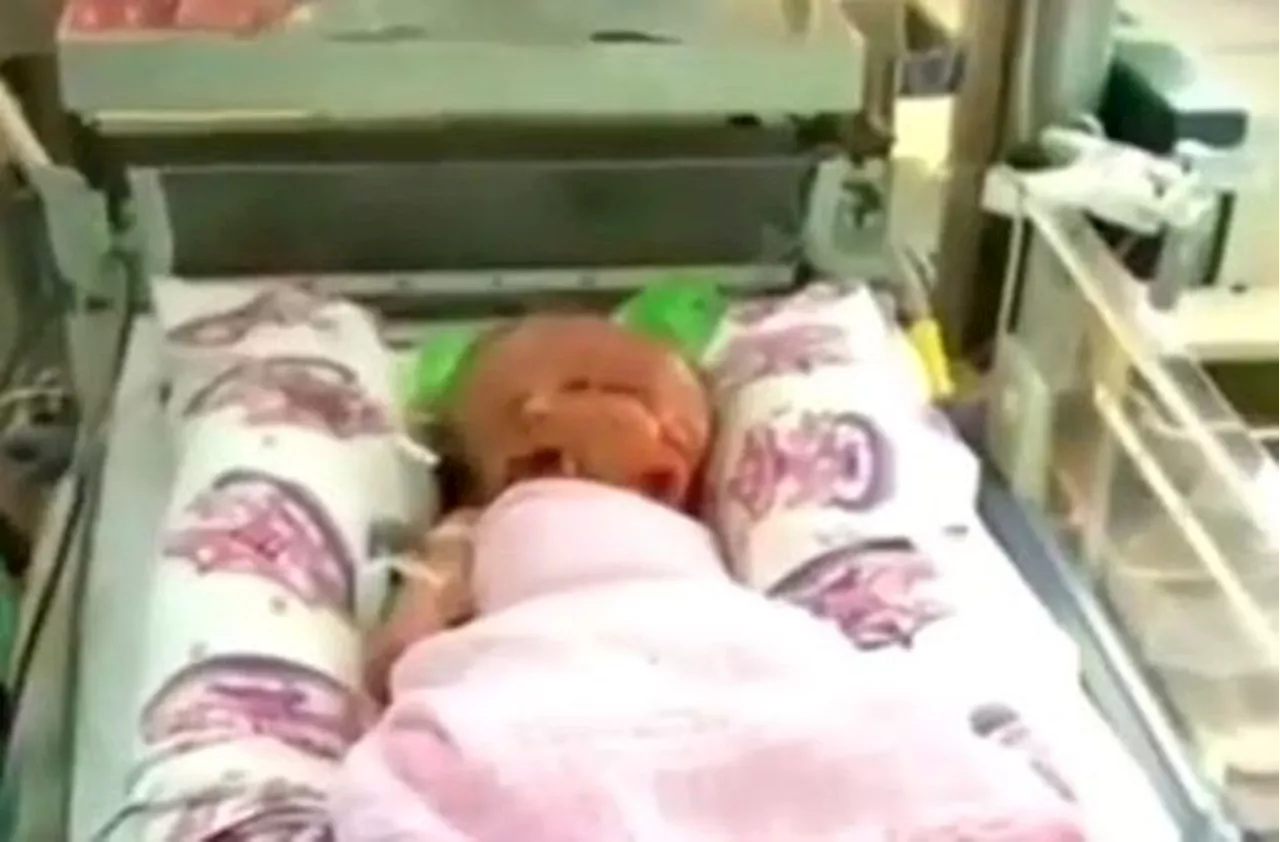 Australian Woman Gives Birth To Rare Conjoined Twins Who Share A Body But Have Two Faces