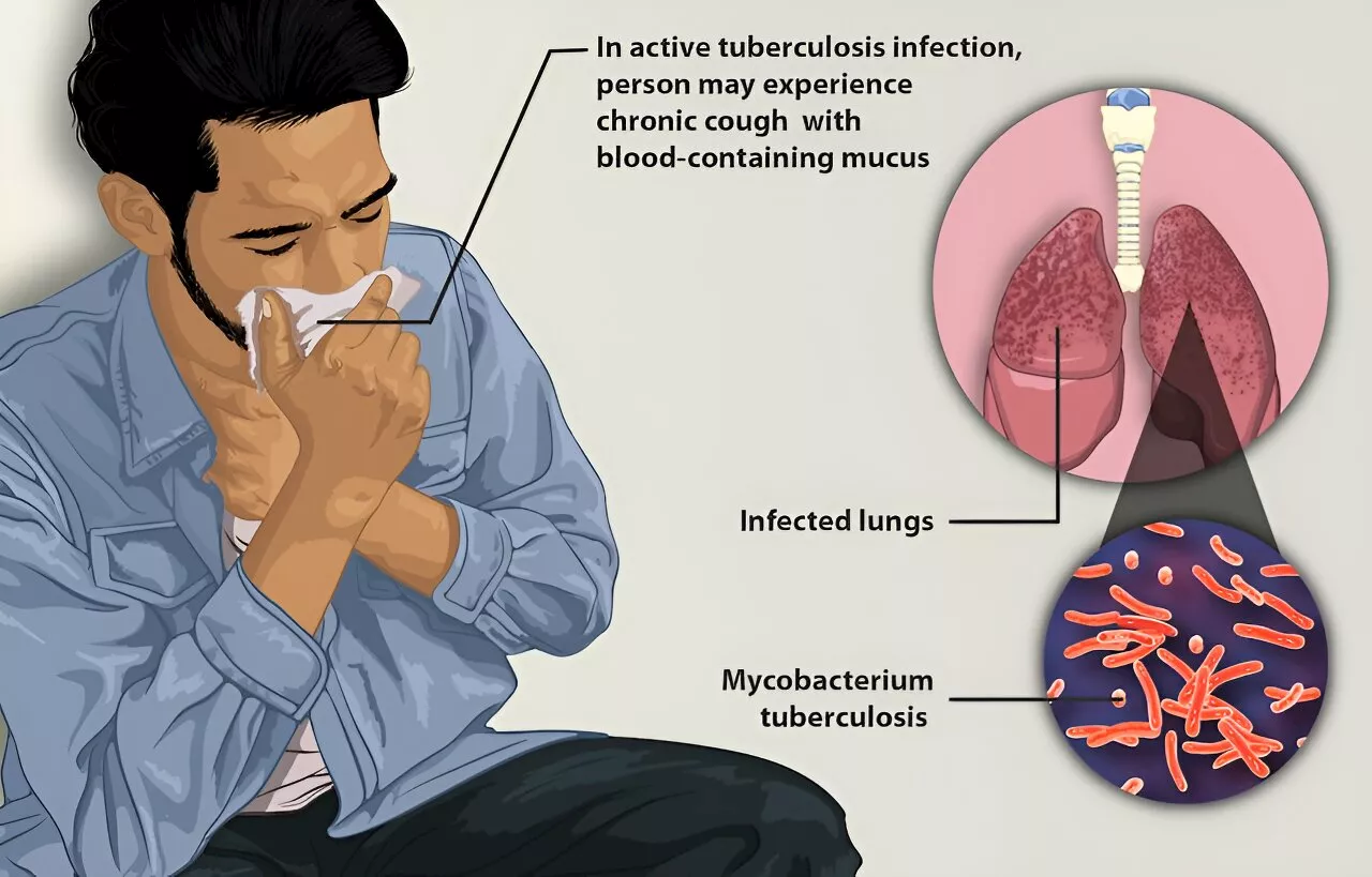 Researchers: Indonesia needs to triple its funding to control tuberculosis—here's where to start