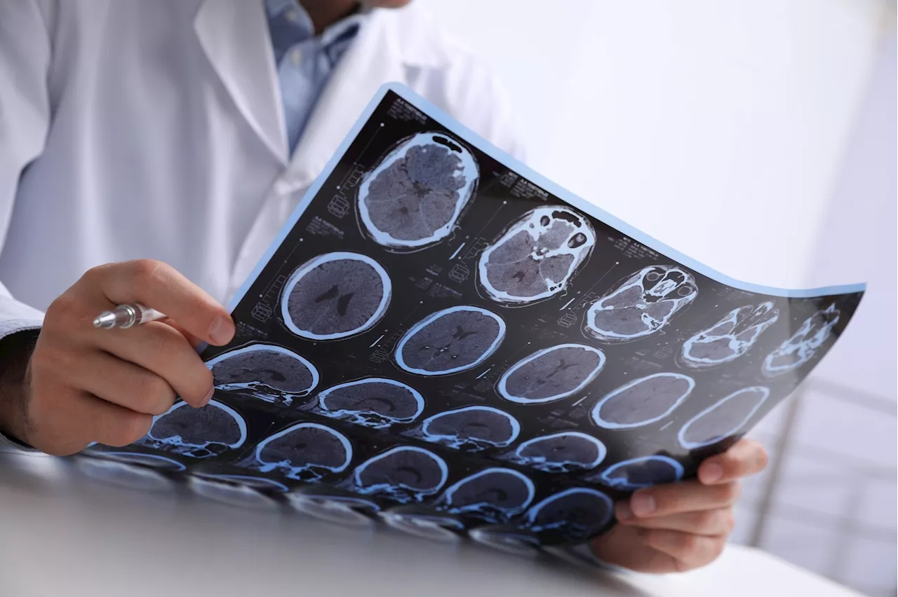 AI-based MRI tools show promise in multiple sclerosis diagnosis