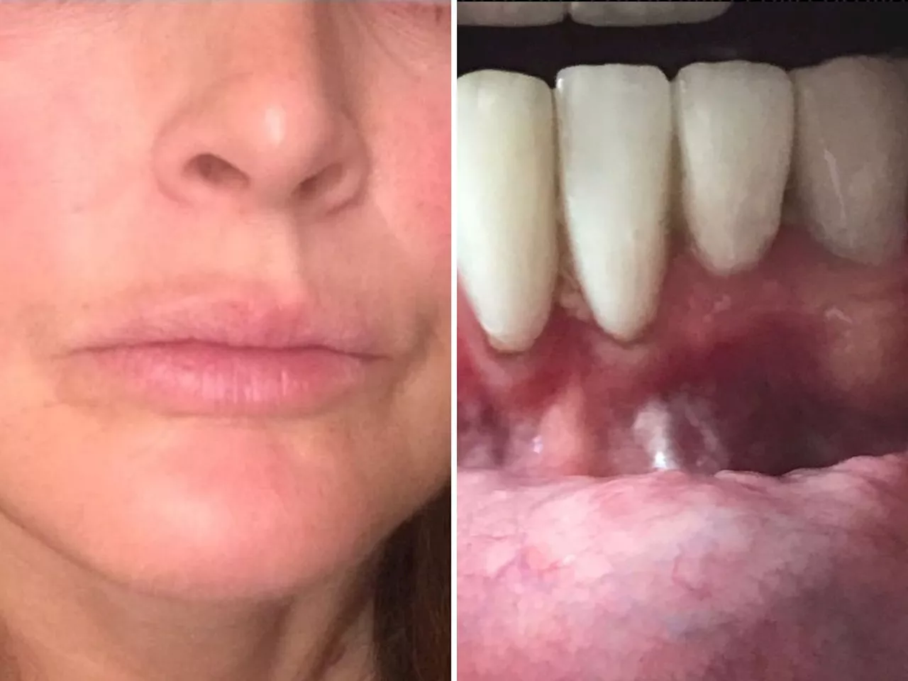 'I was promised a dream but got a nightmare' - Irish woman after dental surgery in Turkey