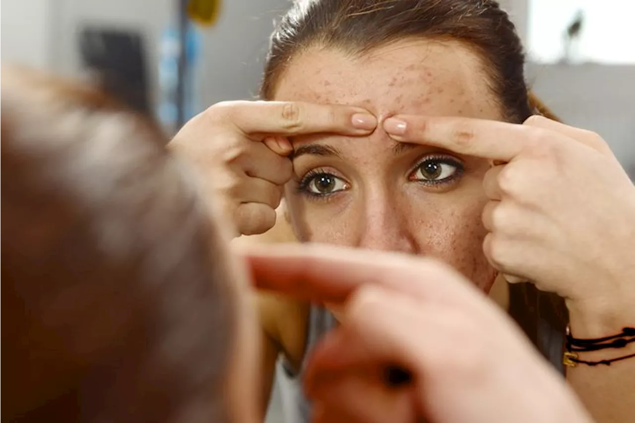 Here’s the reason behind breakouts on each part of your face