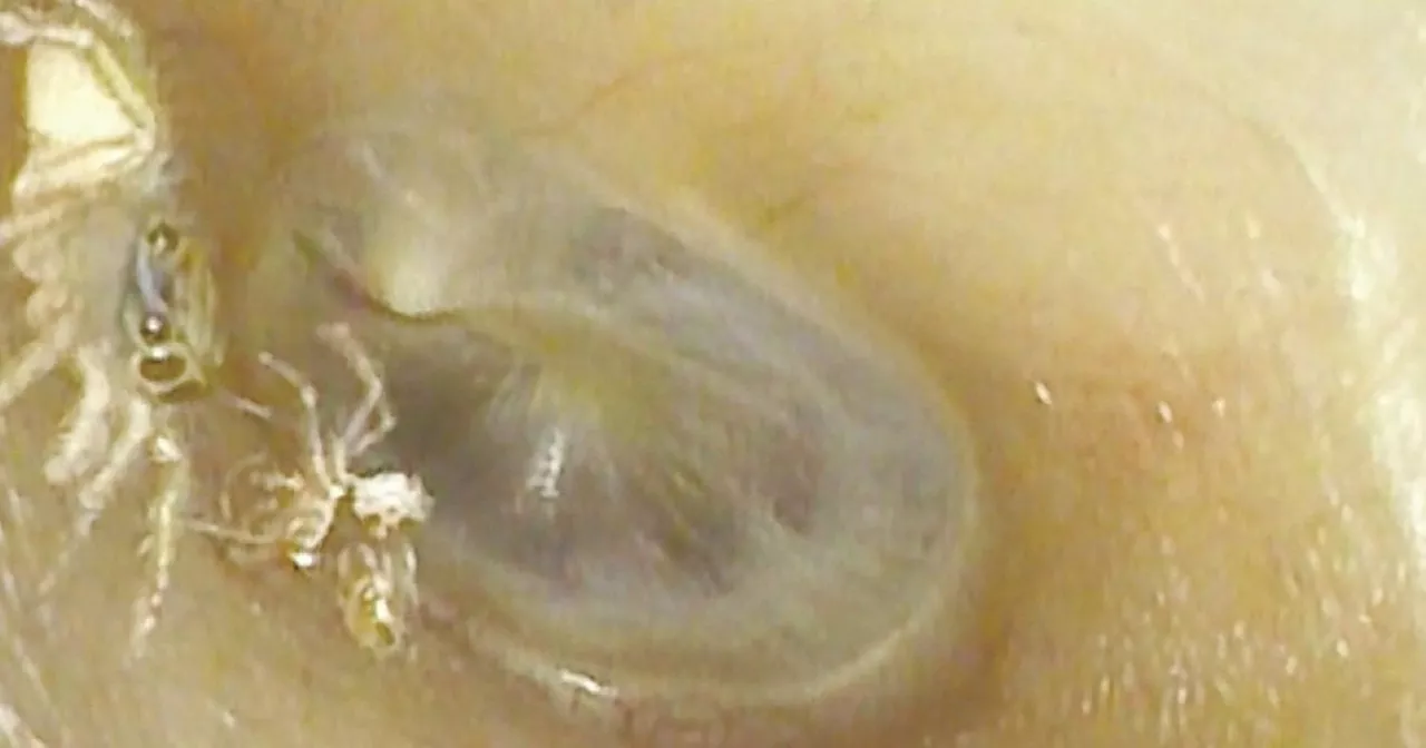 Spider was found inside a woman's ear, according to new report