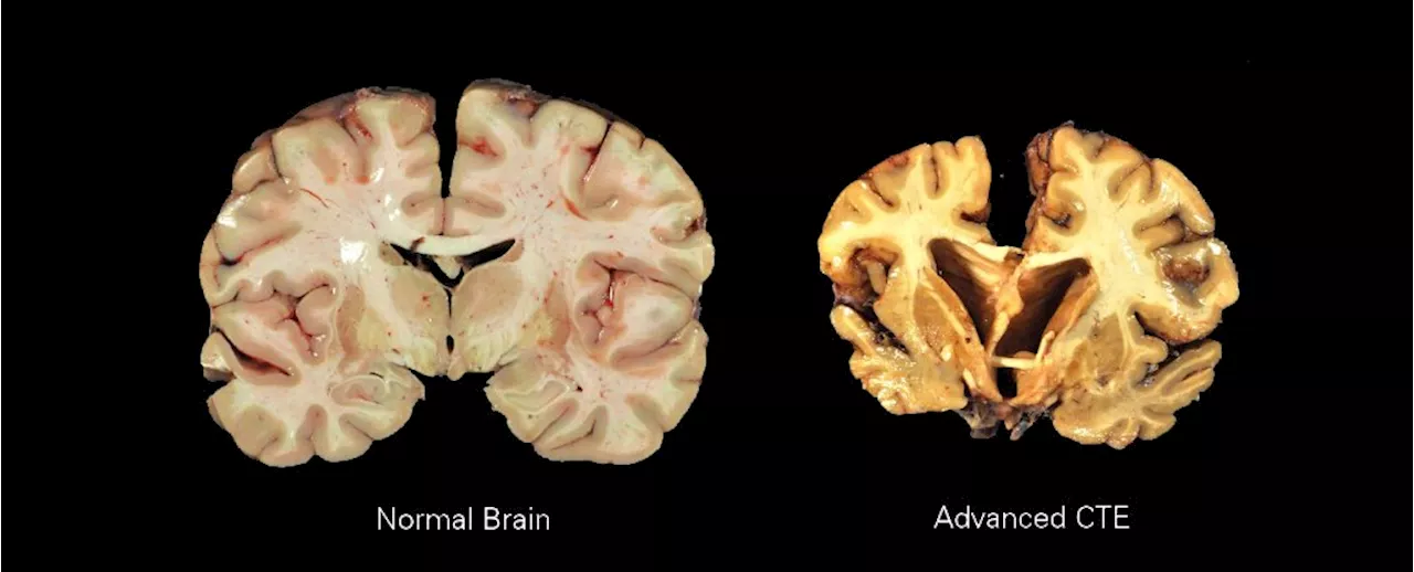 Alarming Study Finds Risk of Brain Disease Rises Every Year You Play Rugby