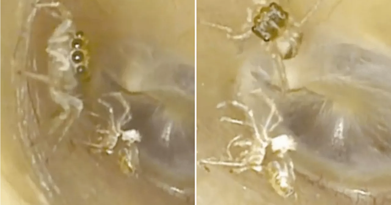Video of tiny spider found in woman’s ear will make your skin crawl
